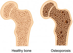 Comparación entre un hueso sano y un hueso con osteoporosis
