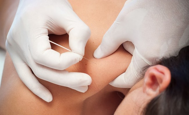 Aplicación de punción seca en fisioterapia sobre el hombro