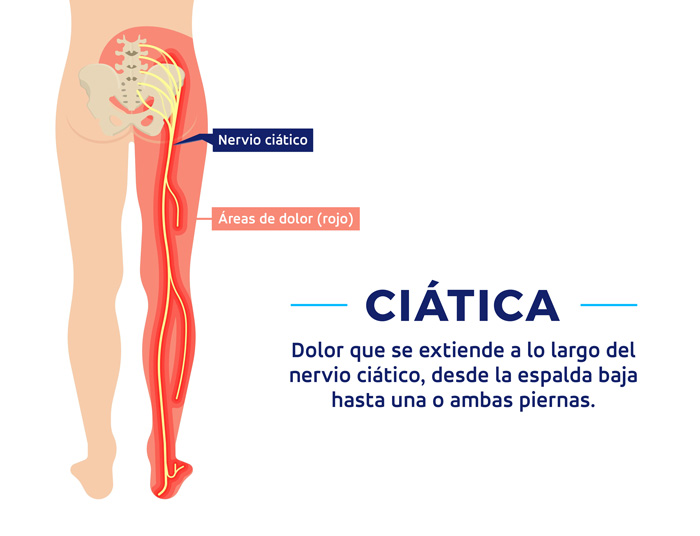 Diagrama del recorrido del nervio ciático y zonas de dolor